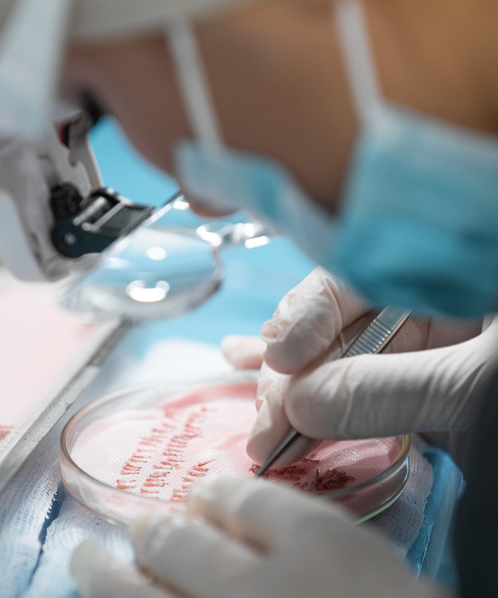 Préparation d’un stylet CHOÏ pour l’implantation capillaire