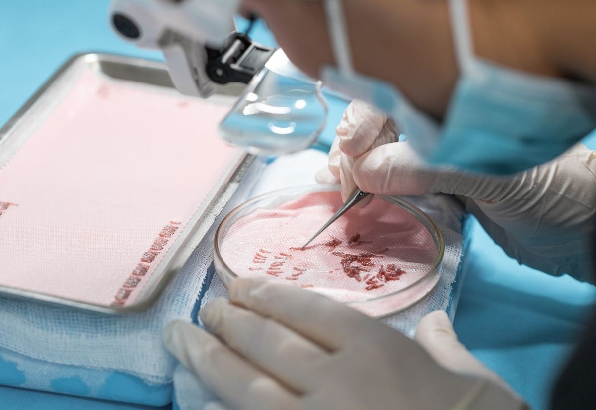 Système de diagnostic de l'alopécie (DSA)