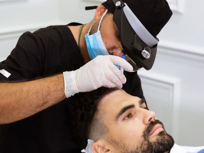 Implantation lors d'une greffe de cheveux DHI chez un homme