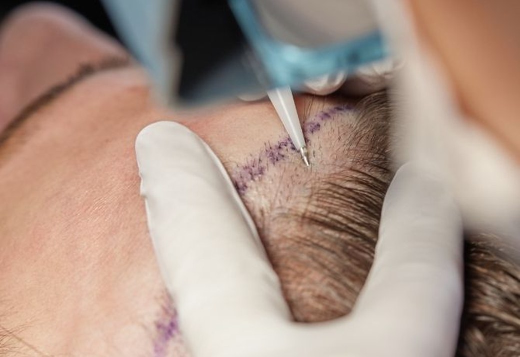Micropigmentation