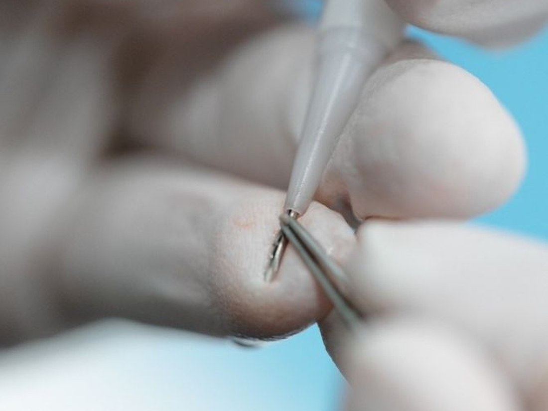 Trichométrie et test d'alopécie